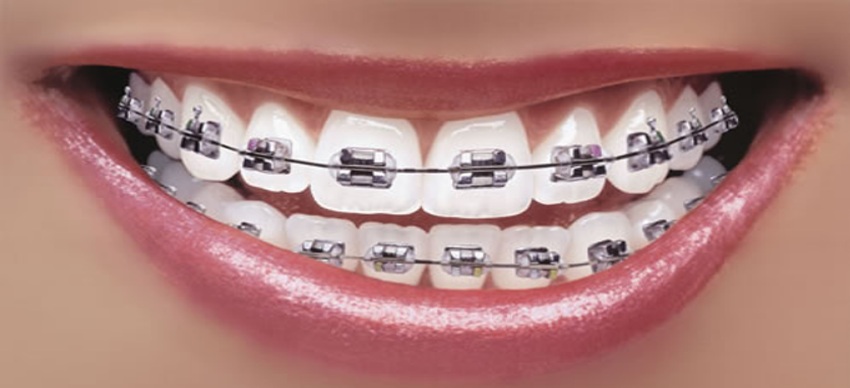 orthodontie adulte